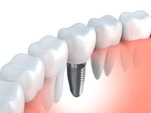 dental implants