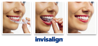 invisalign invisible braces