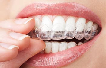 Teeth with Invisalign.