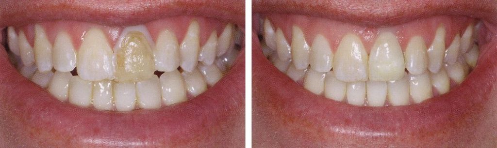 Porcelain crowns before and after.