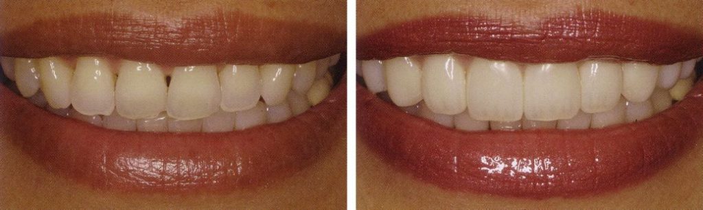 Veneers before and after.