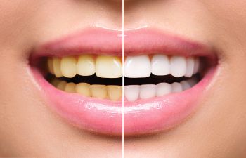 Teeth Whitening Davidson NC