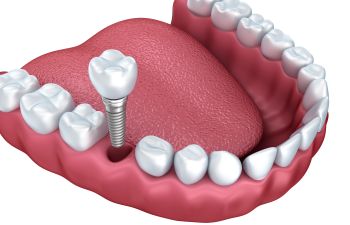 DEntal implant replacing a missing tooth